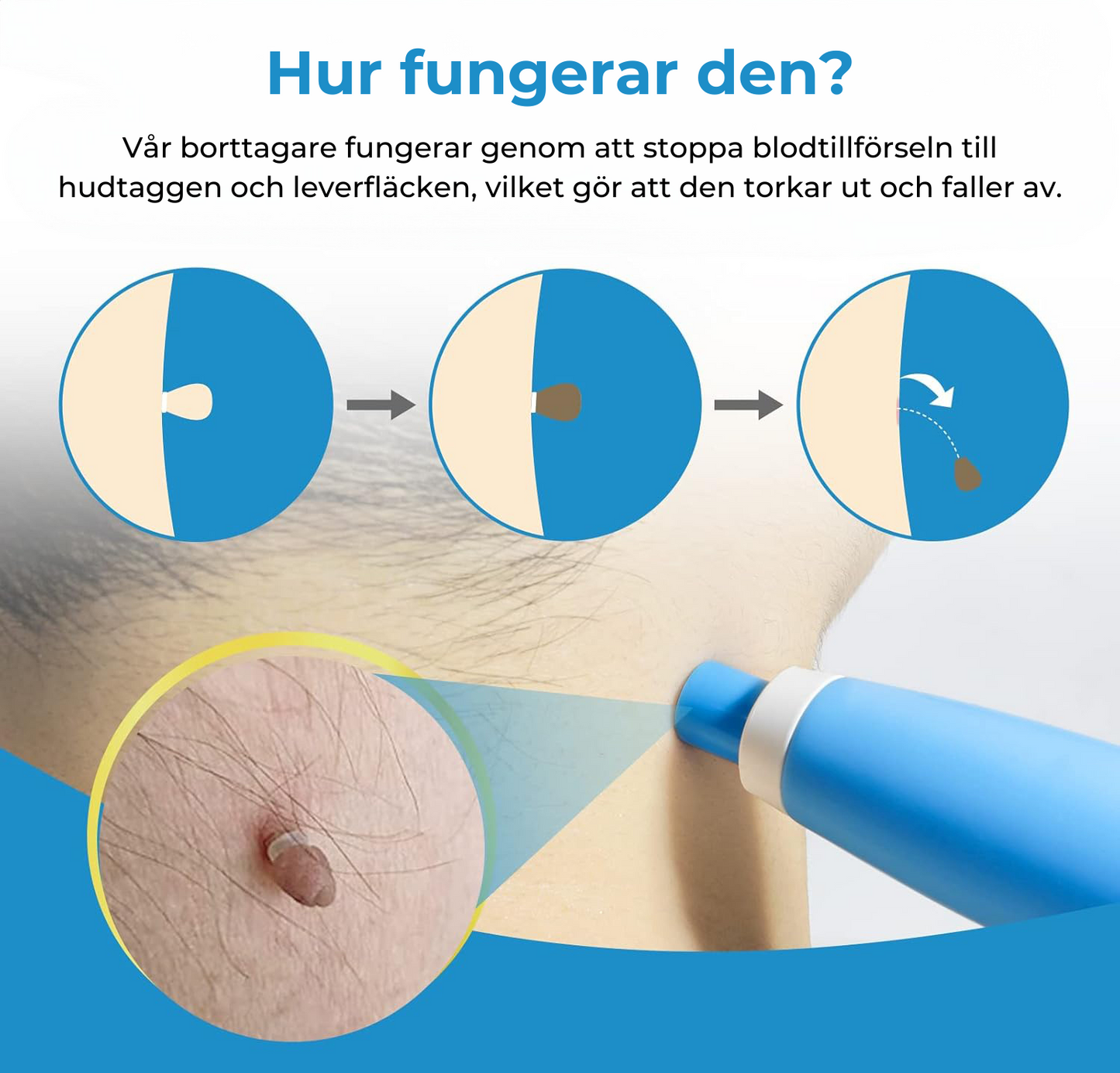 Liver Spot Removal - Removal of Birthmark