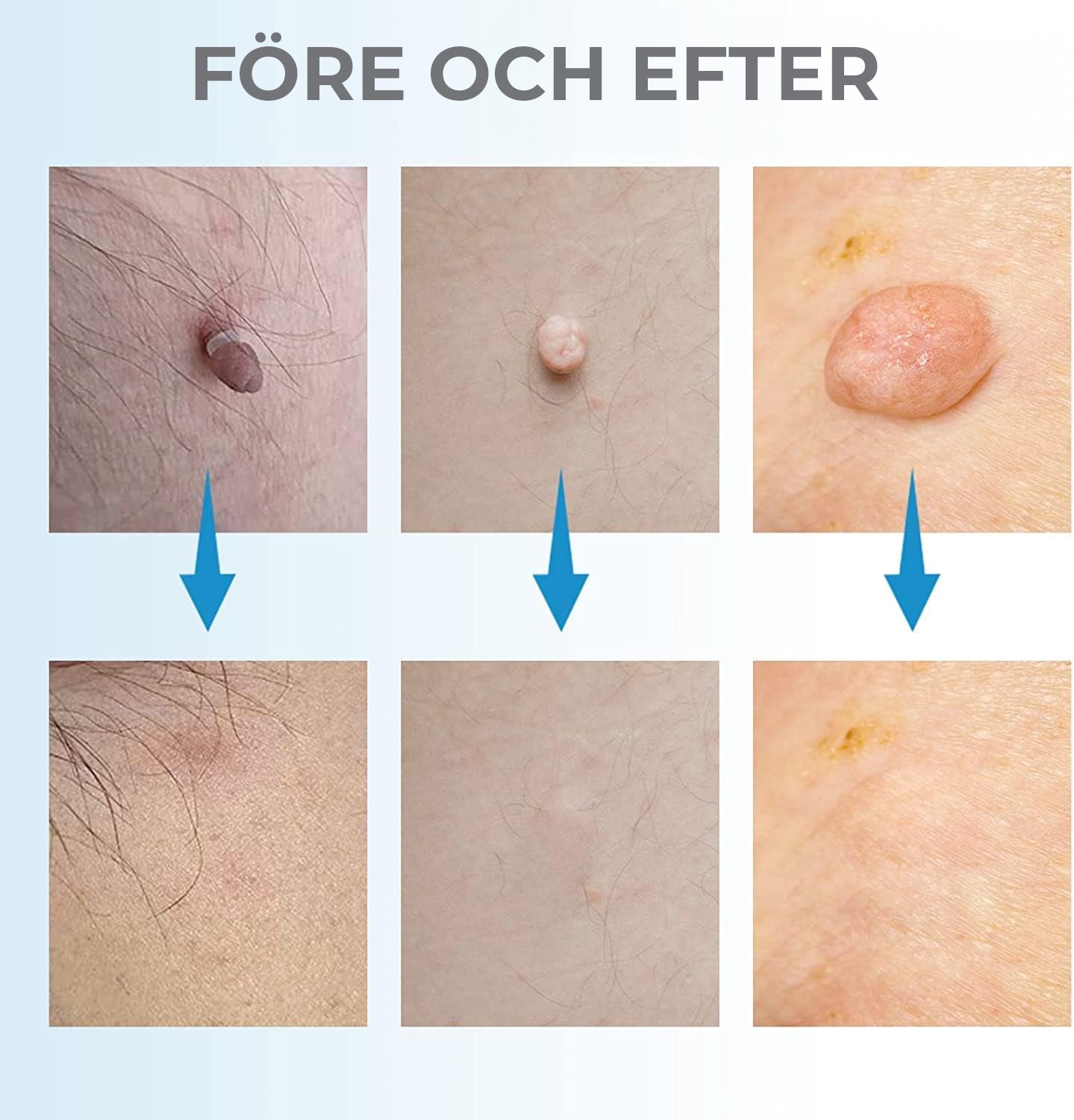 Liver Spot Removal - Removal of Birthmark