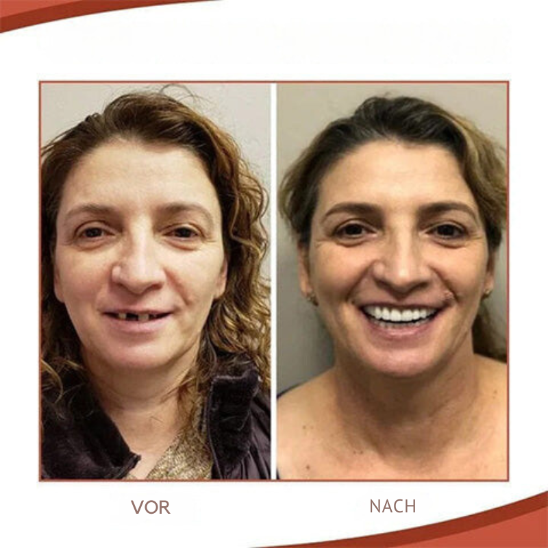 Wearclo | Biocompatible Silicone Prosthesis Set for Pain-Free Fit and Natural Smile