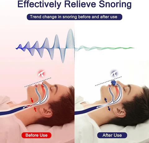 Wearclo | Micro CPAP Anti-Snoring Device | Maskless Sleep Apnea Treatment