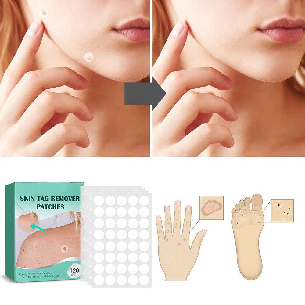 Wearclo | SkinClear Skin Tag Remover | Plaster for the Removal of Skin Tags & Warts | Hydrocolloid Technology | Pain-Free & Discreet | For All Skin Types | 144 Pieces