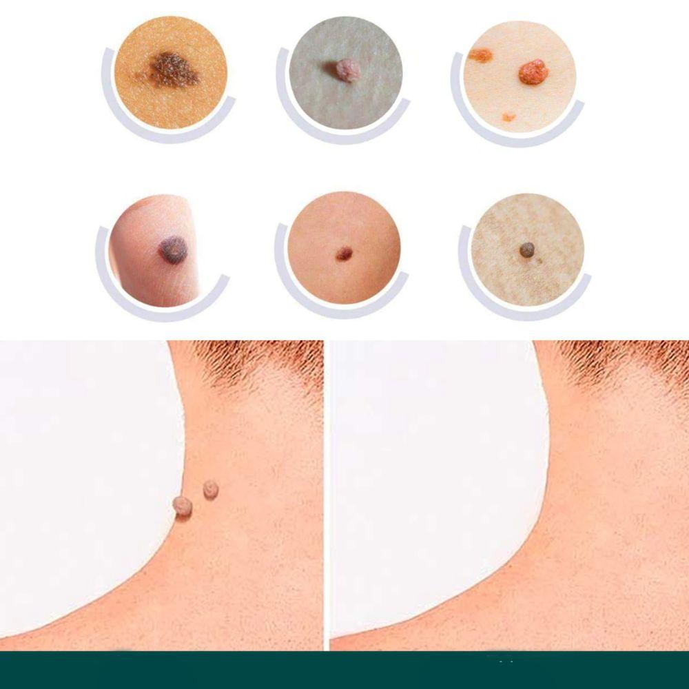 Wearclo | SkinClear Skin Tag Remover | Plaster for the Removal of Skin Tags & Warts | Hydrocolloid Technology | Pain-Free & Discreet | For All Skin Types | 144 Pieces