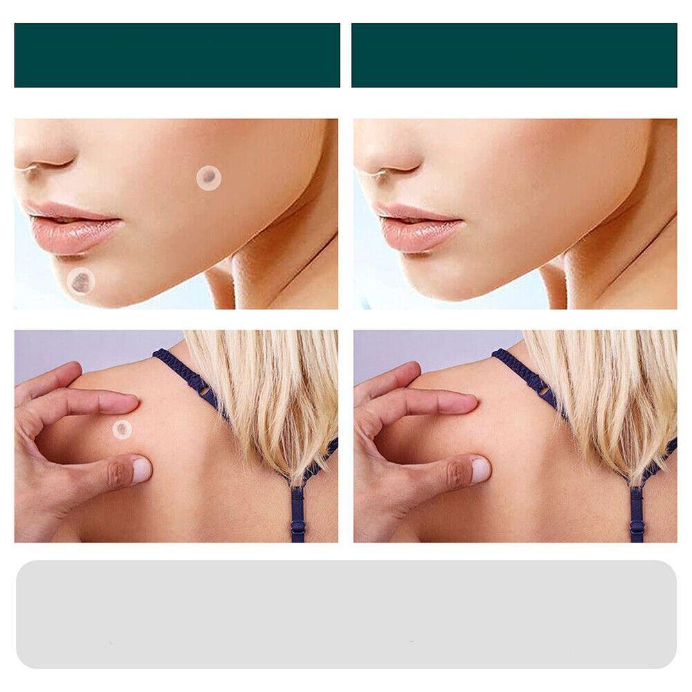Wearclo | SkinClear Skin Tag Remover | Plaster for the Removal of Skin Tags & Warts | Hydrocolloid Technology | Pain-Free & Discreet | For All Skin Types | 144 Pieces